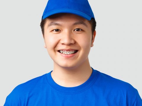 Trade Metal Braces For Clear Aligners