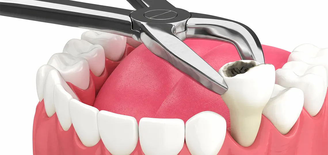 Tooth Removal/Extractions in Bayside, NY