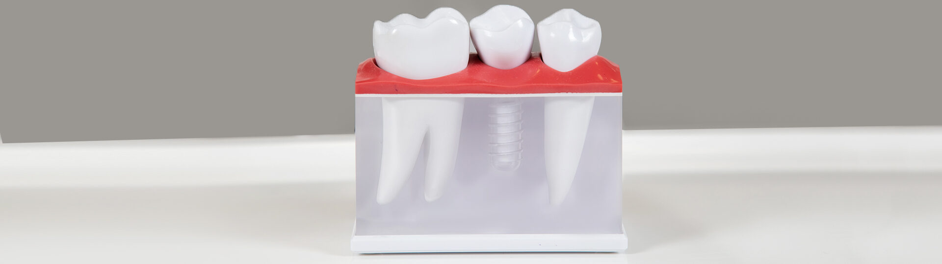 The Benefits of Choosing Dental Implants