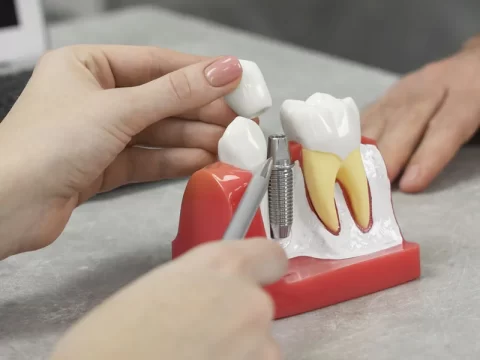 Why Dental Implants Are the Most Natural-Looking Tooth Replacement Option