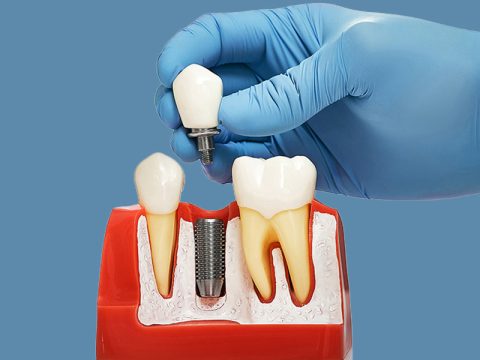 How Dental Implants Improve Oral Health and Confidence