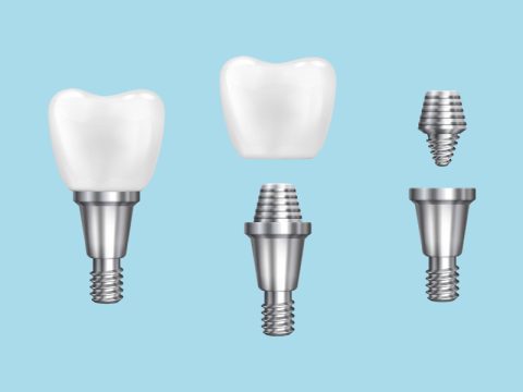 Save $500 on Dental Implants in Bayside, NY: Everything New Patients Need to Know